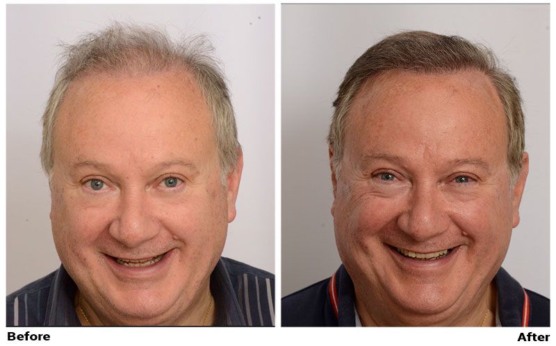 Exosome Hair Therapy Before & After