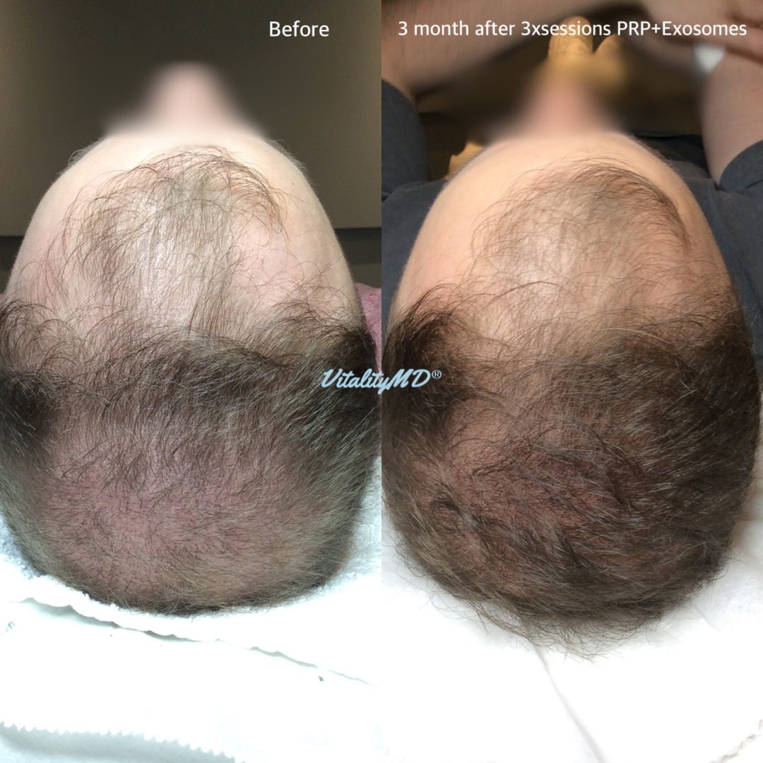 Before and After-PRP & Exosomes (1)