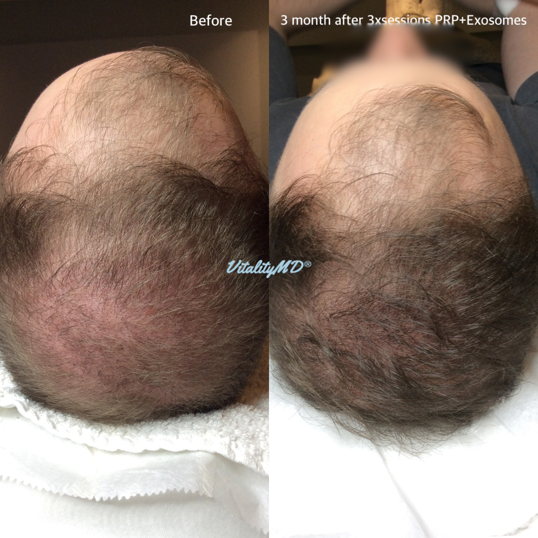 Before and After-PRP & Exosomes (2)