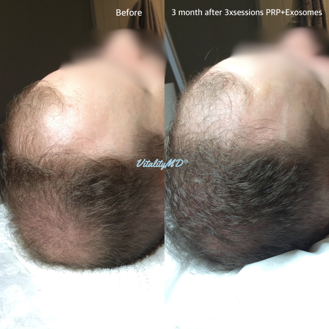 Before and After-PRP & Exosomes (3)