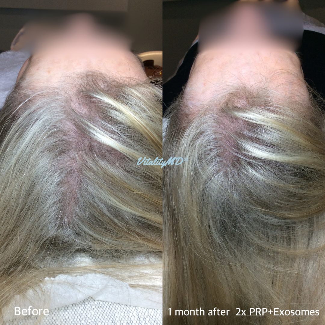 Before and After-PRP & Exosomes (4)