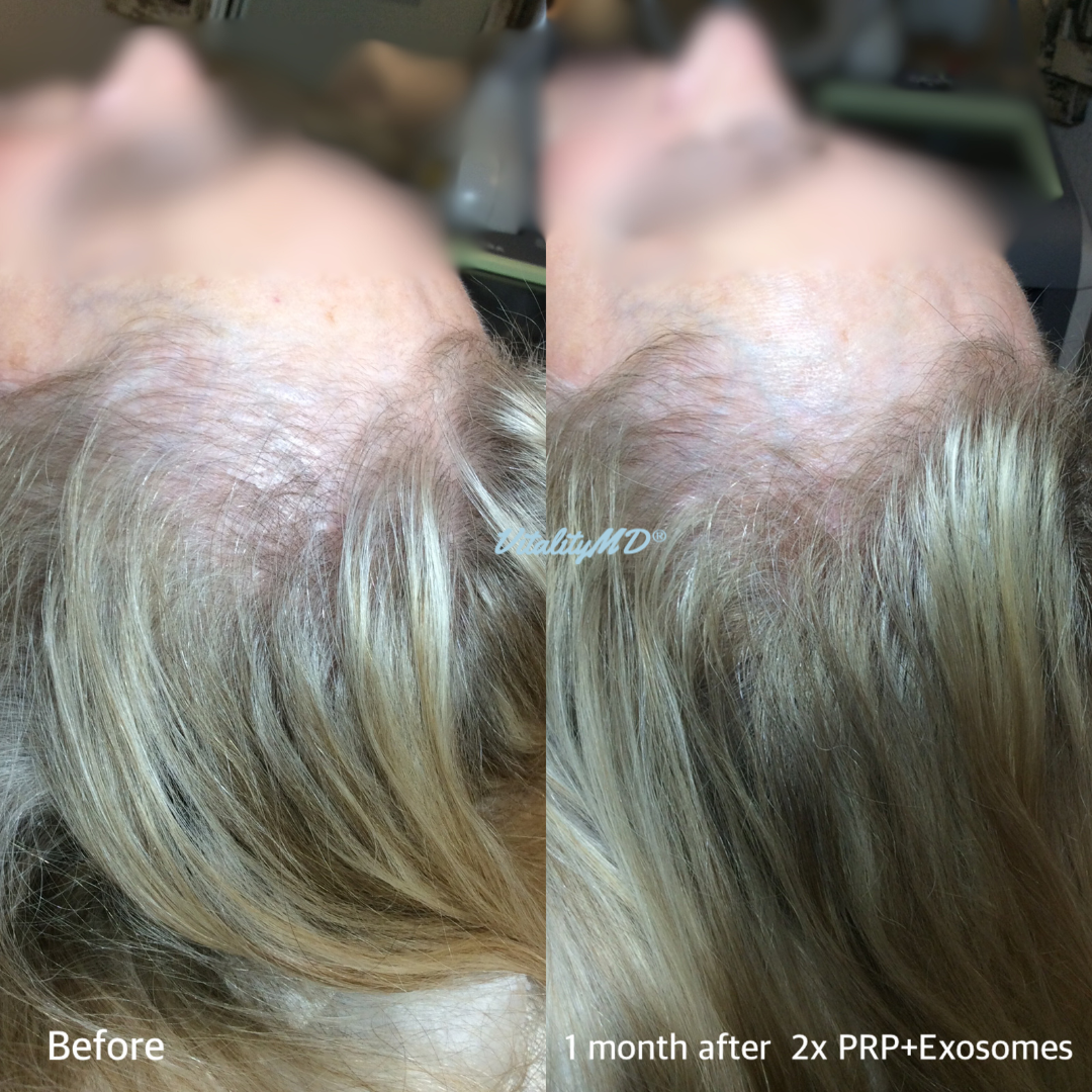 Before and After-PRP & Exosomes (5)