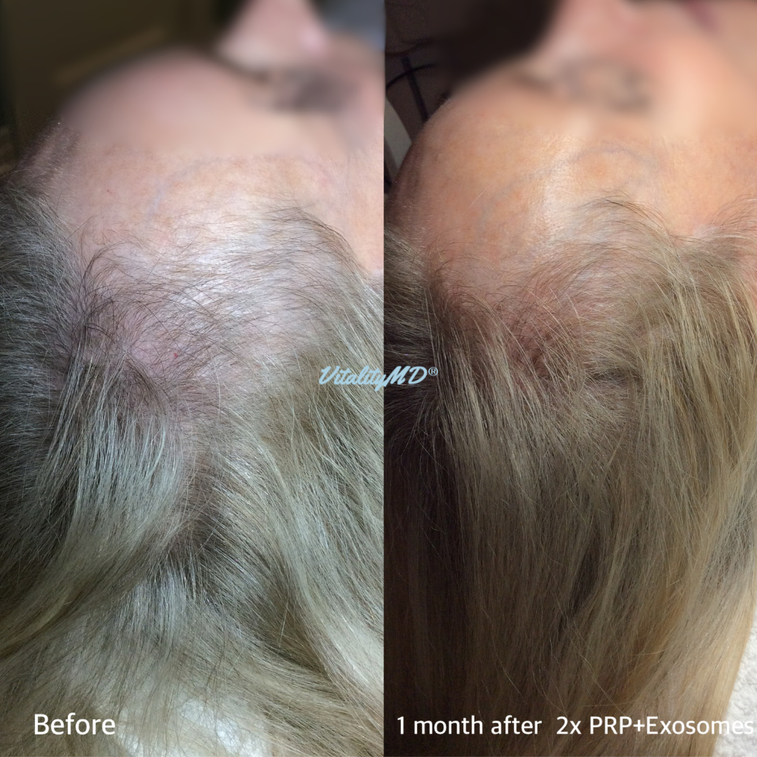 Before and After-PRP & Exosomes (6)