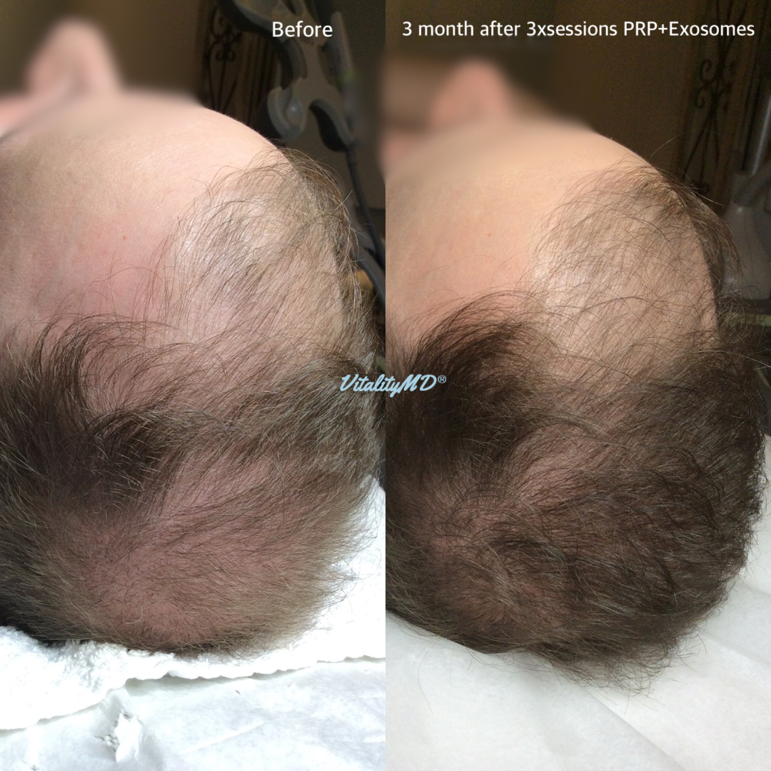 Before and After-PRP & Exosomes